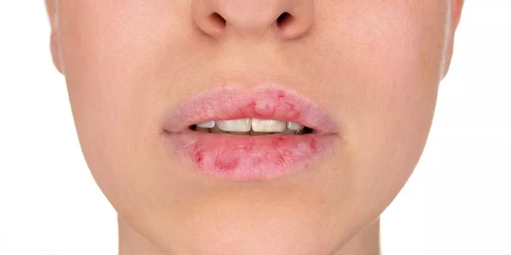 جمالك يهمنا.. "العسل والخيار"| 6 طرق طبيعية لـ علاج تشقق الشفاه خلال رمضان