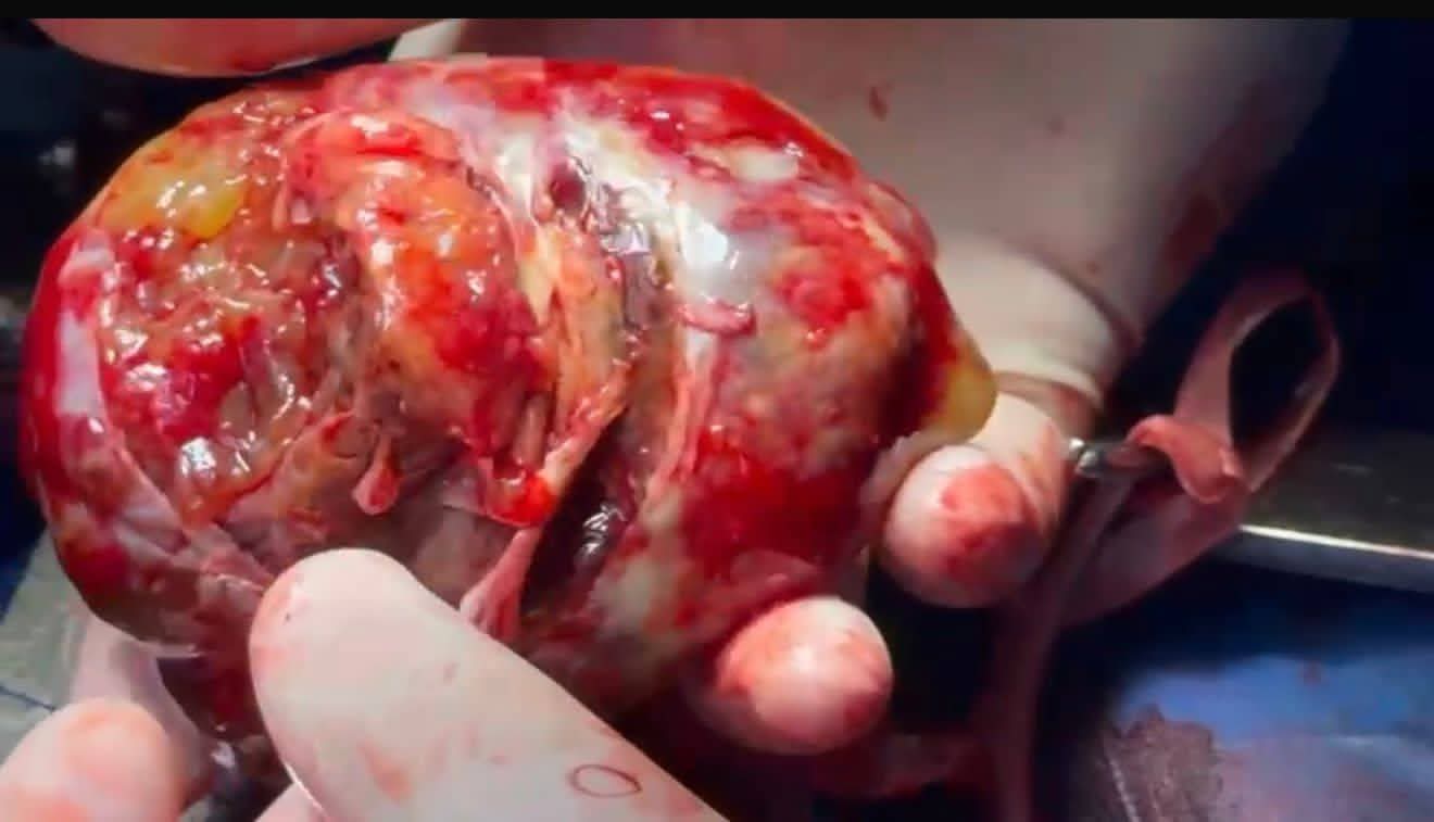 نجاح فريق قصر العيني استئصال ورم نادر من قلب مريض يبلغ من العمر ٧٠ عاما