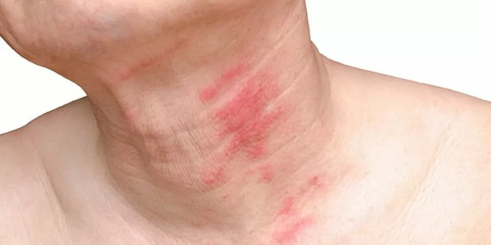 الحزام الناري المرض الذي لا يحظى بالنقاش الكافي .. إحذروا منه