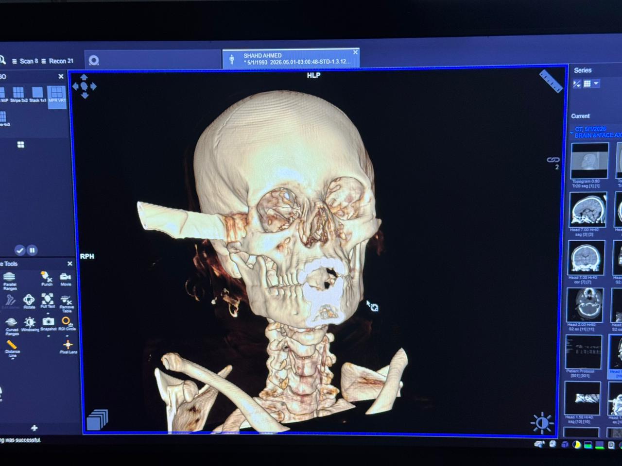 فريق طبي قصر العيني ينقذ مريضة شابة في جراحة دقيقة لاستخراج سكين من قاع الجمجمة