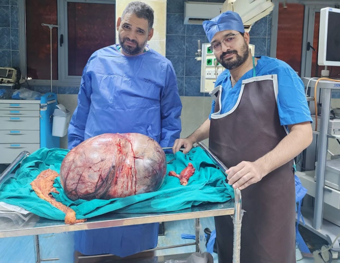مستشفيات جامعة المنيا تنجح في استئصال ورم مبيضي نادر يزن 24 كيلوجرامًا